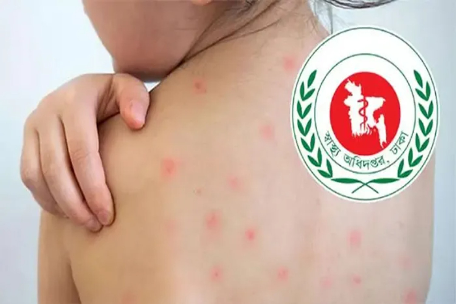 হাম ও উপসর্গে আরও ৪ শিশুর মৃত্যু